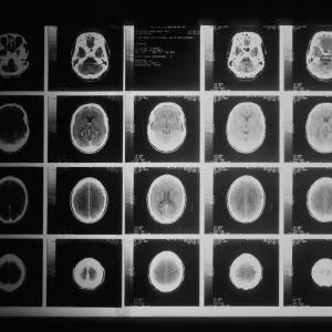 Multiple brain scans displayed side by side, showing different views and sections of the brain
