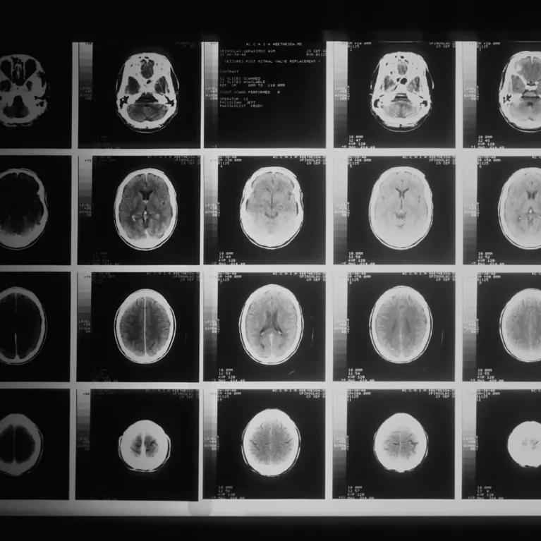 Multiple brain scans displayed side by side, showing different views and sections of the brain